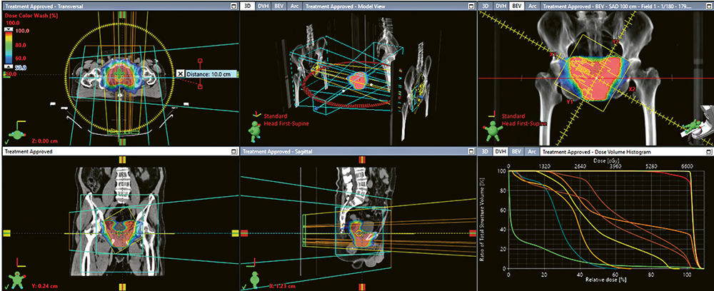 醫院物理學家<br/>為癌症病人精準計算治療輻射量 醫院物理學家<br/>為癌症病人精準計算治療輻射量
